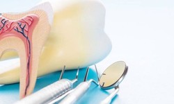 Benefits of Getting Dental Implants