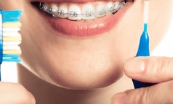 How do you maintain your Invisalign?