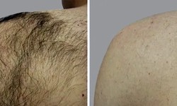 How Safe Is Laser Hair Removal?
