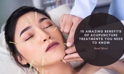 10 Amazing Benefits of Acupuncture Treatments You Need to Know