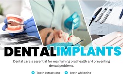 Are Dental Implants Safe or Not ?