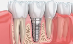 Finding the Best Dentist in Mooresville: Tips and Recommendations