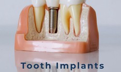 What are the side effects of Tooth implants?