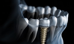 Advanced dental implants to restore your smile