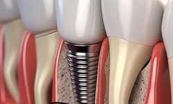 Get the Best Dental implants in camas wa