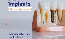 Dental implants placement: A Technique of Modern Dentistry