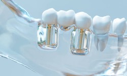 What Are Dental Implants Therapy ?