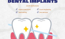Why Choose Camas Periodontics for Dental Implants ?