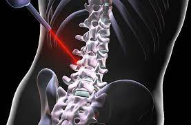 Benefits of Laser Spine Surgery