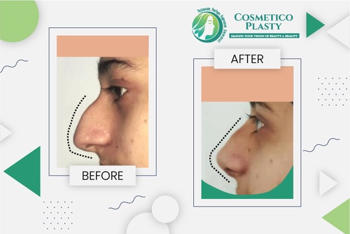 How long is Rhinoplasty Recovery Time