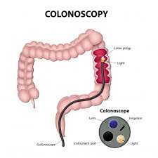 Colonoscopy: Why is it necessary to perform one?