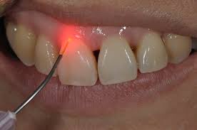 The Advancements In Dental Lasers Manufactured By Top Brands