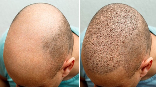 Choosing The Right Hair Restoration Doctor: Tips And Factors To Consider