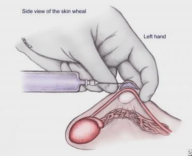 No-Scalpel Vasectomy: A Minimally Invasive Option for Permanent Male Contraception
