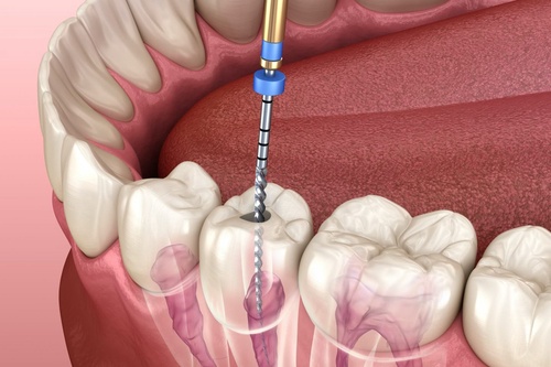 Why Dentists Prefer Root Canal Treatment ?