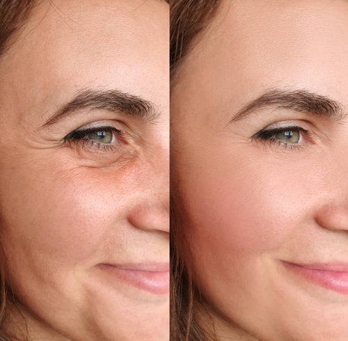 Botox Injections: A Non-Surgical Approach to Wrinkle Reduction