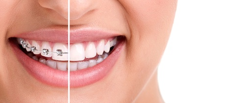 Smile with Confidence: The Advantages of Dental Braces for Adults