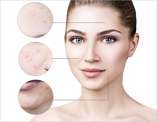 Are Korean Hydrocolloid Acne Patches The Solution For Stubborn Acne? Find Out Below…