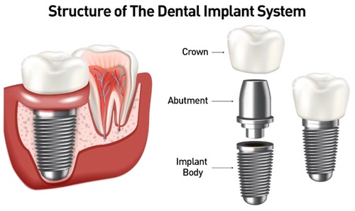 Complete Guide to Dental Implants Treatment in Aberdeen