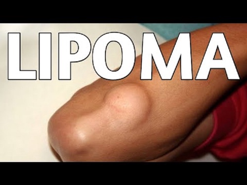 Natural Remedies for Lipoma Treatment at Home