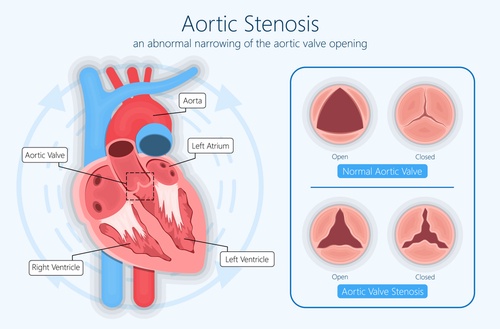 Aortic Surgery and its benefits