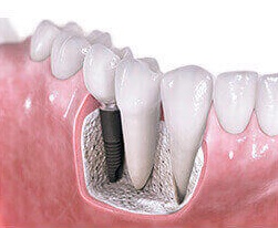 What Are The Considerations When Choosing Dental Crown Material?
