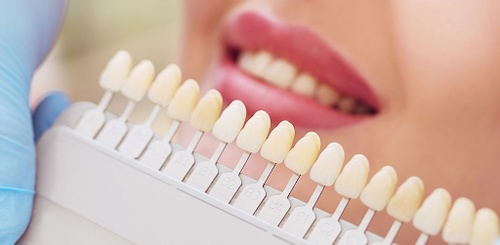 Choosing the Right Dentist for Porcelain Veneers: Your Guide to a Perfect Smile