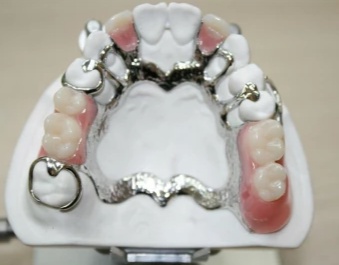 Are Partial Dentures The Best Treatment For Missing Teeth?