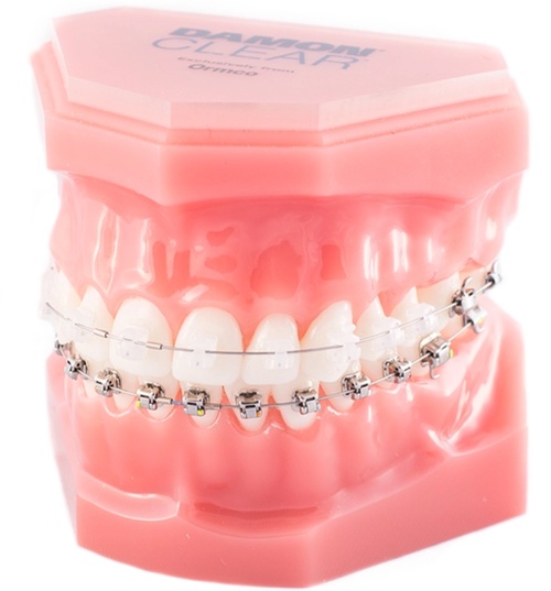 How to discover the Benefits of Invisalign Treatment in Garland?