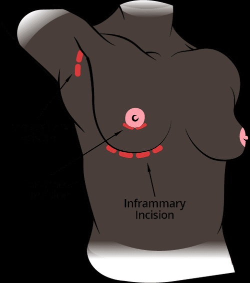 Is Inverted Nipple Correction Surgery Right for You: Learn More?