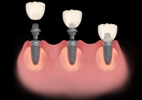 Advanced Dental Implants for Young Adults: When and Why They Are Recommended