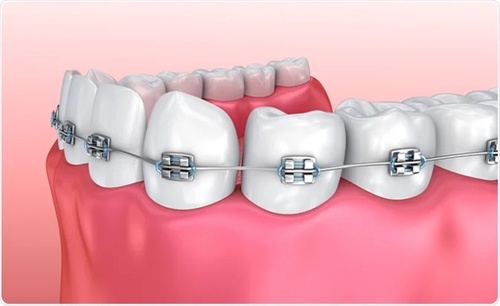 Give The Best Care to You Teeth with Best Braces Treatment