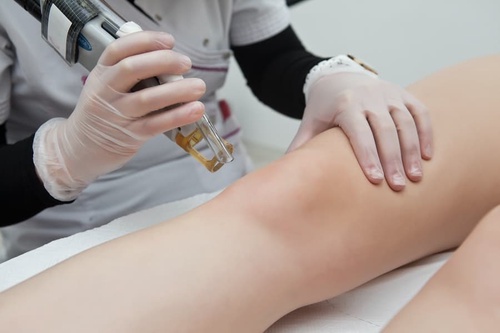 Laser Therapy for Stretch Mark Reduction: An Effective Solution