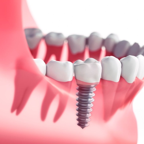 How to Choose the Right Dental Implants for You