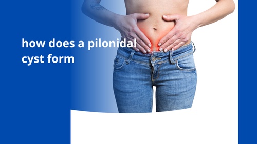 How Comes Up With A Pilonidal Cyst?