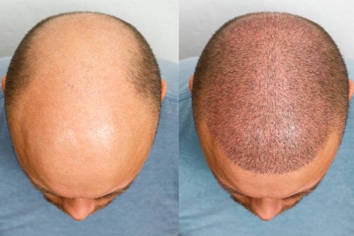 Follicle Refreshment Process: Hair Restoration