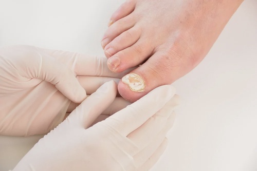 Unveiling the Ultimate Nail Fungus Treatment in Australia