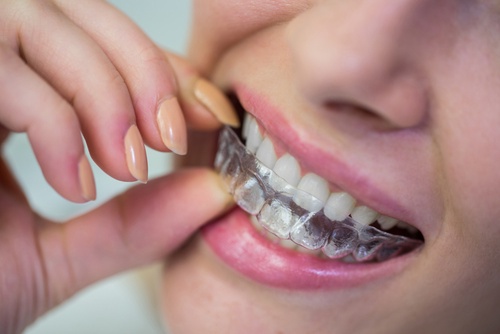 Invisalign Attachments: Austin Dentist's Secret