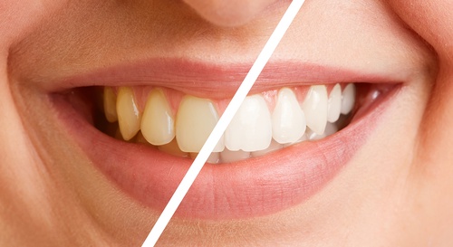 The Blueprint to Dazzling Smiles: Teeth Cleaning in Dubai