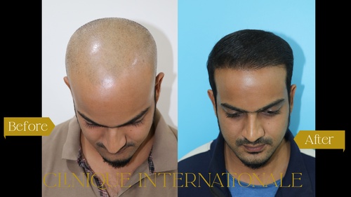 Understanding Hair Transplant Costs at Clinique Internationale, Pune: A Comprehensive Guide
