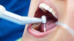 Root Canal Treatment and Its Impact on Overall Health