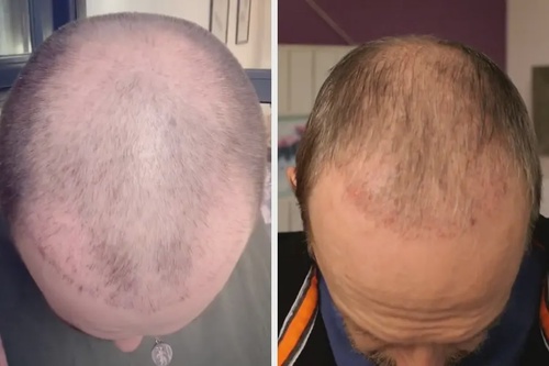 Advancements in Hair Transplant Technology