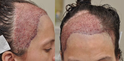Graft Placement in Hair Transplant Treatment