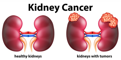 Understanding Kidney Cancer: A Comprehensive Overview