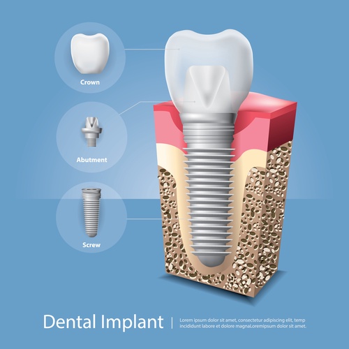 The Benefits of Dental Implants: A Comprehensive Guide