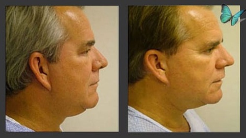 Outpatient Neck and Facelift Surgery: Rejuvenation with Local Anesthesia