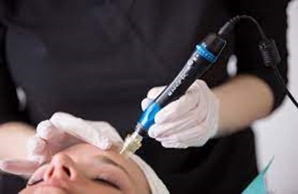 The Four Most Amazing Advantages of Microneedling Therapy
