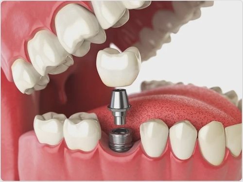 Rediscover Confidence with Dental Implants in Dubai