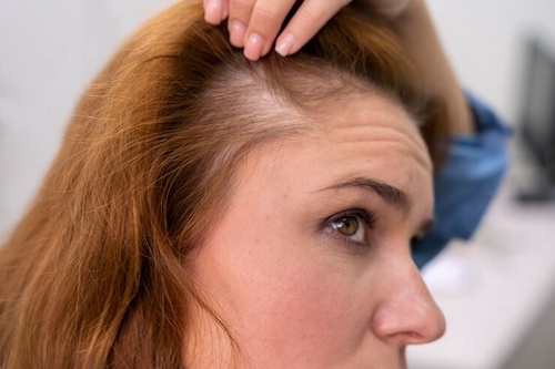 Feminine Follicles: The Rise of Hair Transplants for Women