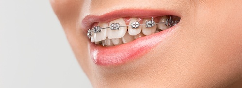 4 Compelling Reasons to Get Braces as an Adult